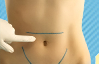 Умбиликопластика