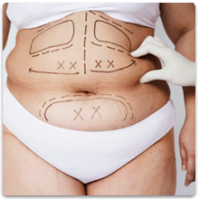 Пластическая операция по абдоминопластике