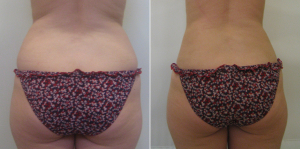 Радиочастотная липосакция до и после у Светланы Пшонкиной