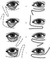 операция по исправлению эктропиона, выворота века