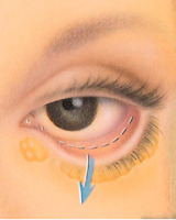 Эктропион, или выворот века