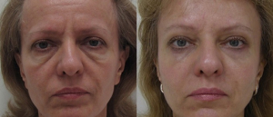 Эндоскопическая подтяжка у Александра Гуляева