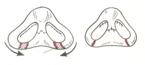 Пластика ноздрей