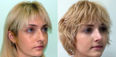 Фото до и после ринопластики у Светланы Пшонкиной