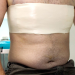 Операция по уменьшению груди у мужчин набирает популярность