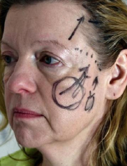 Лифтинг средней трети лица