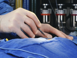 Пластика втянутых сосков