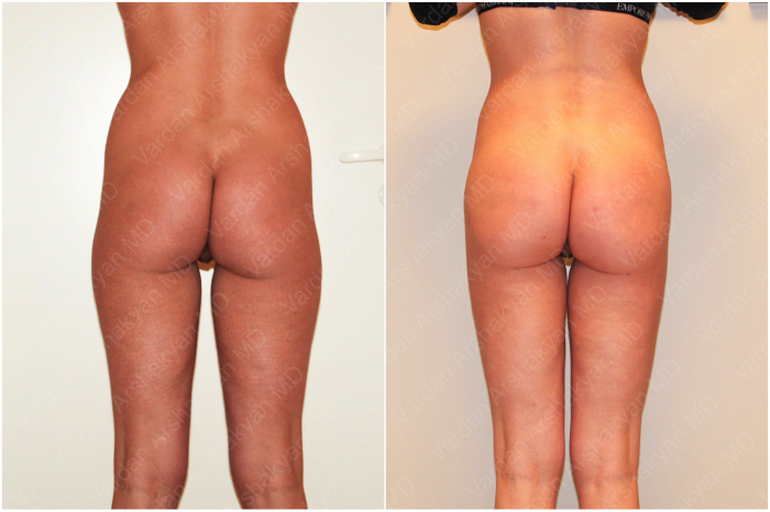 Пациентка пластического хирурга Вардана Аршакяна до и после липофилинга ягодиц