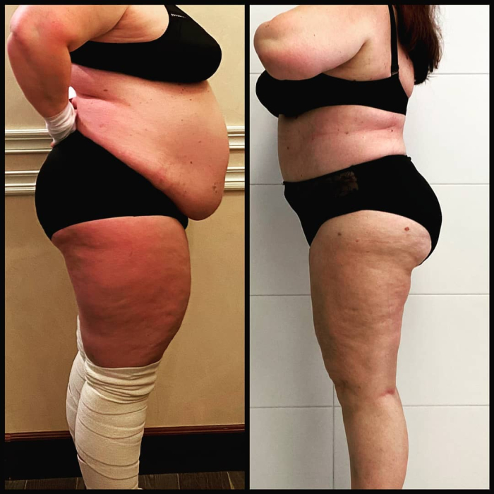 Пациентка доктора Дмитрия Рябцева до и после абдоминопластики