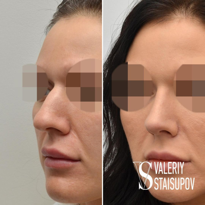 Пациентка пластического хирурга Валерия Стайсупова до и после ринопластики