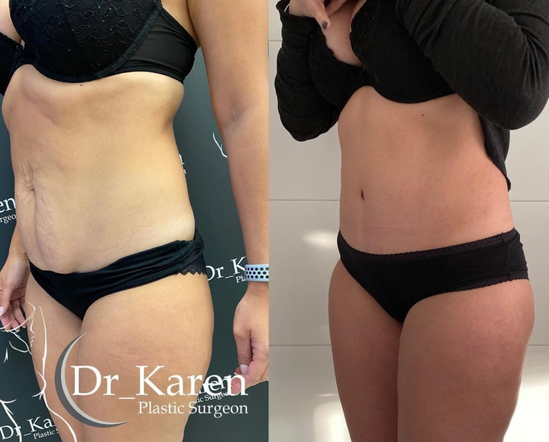 Пациентка пластического хирурга Карена Пайтяна. Фото до и после абдоминопластики.