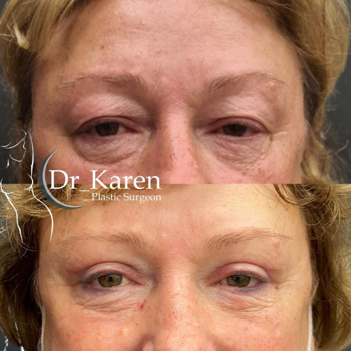 Пациентка доктора Карена Пайтяна до и после верхней блефаропластики
