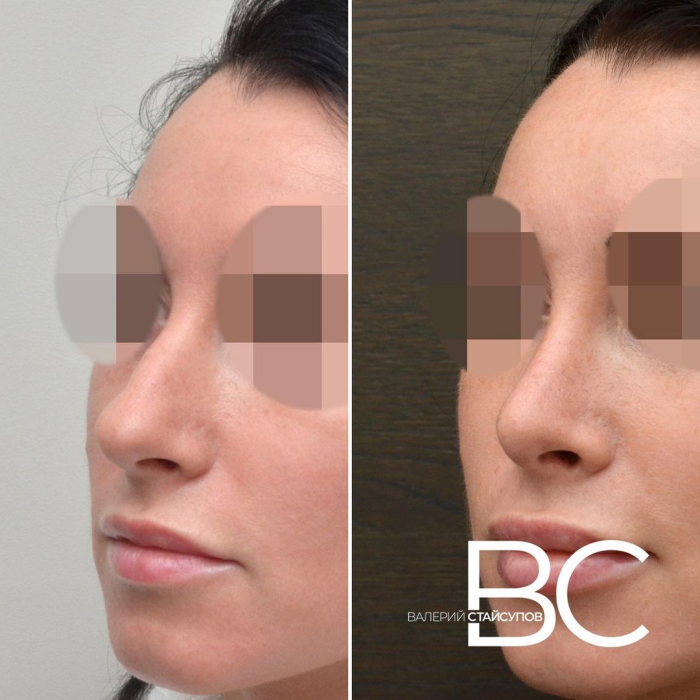 Пациентка доктора Валерия Стайсупова до и после ринопластики