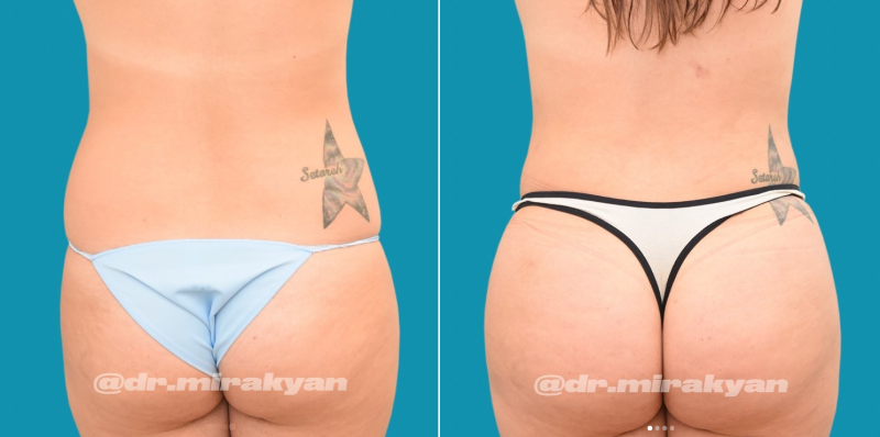 Пациентка пластического хирурга Гукаса Миракяна до и после липофилинга ягодиц