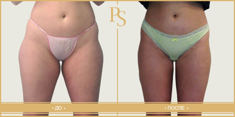 до и после липосакции Пшонкина