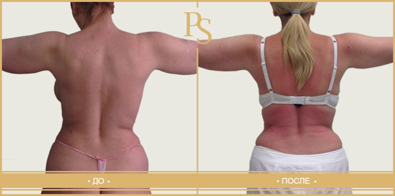 липосакция рук и спины