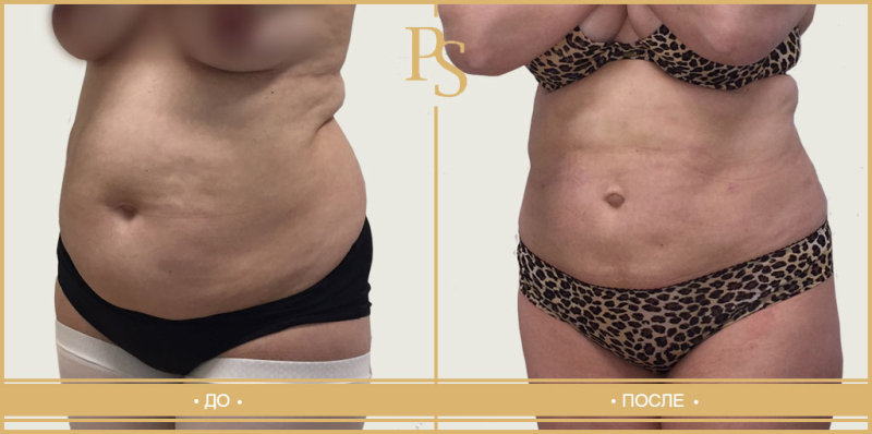 до и после липосакции фото