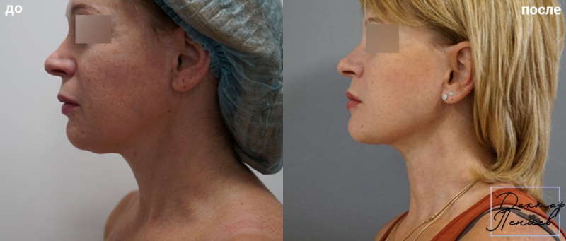 Пациентка пластического хирурга Арслана Пенаева до и после подтяжки лица