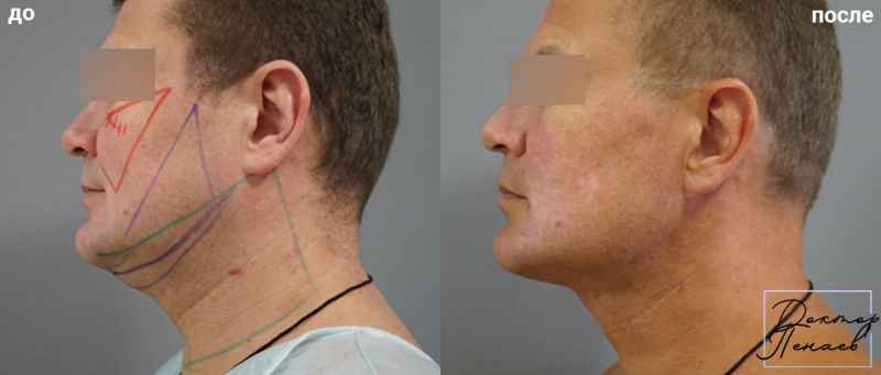 Пациент пластического хирурга Арслана Пенаева до и после подтяжки лица нитями Spring Threads