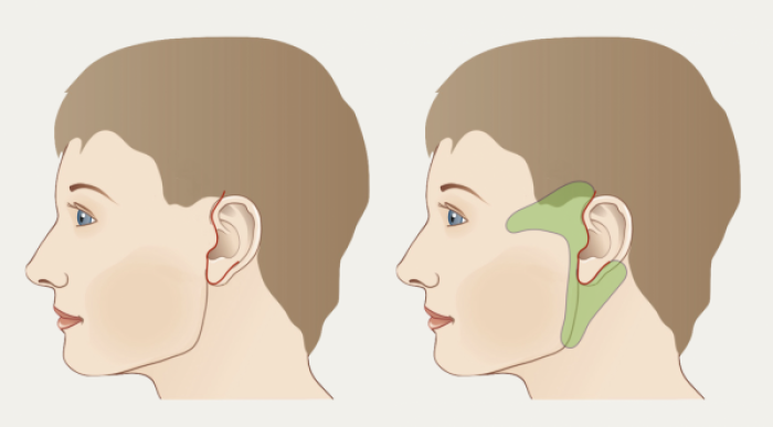 Короткорубцовая подтяжка S Lifting