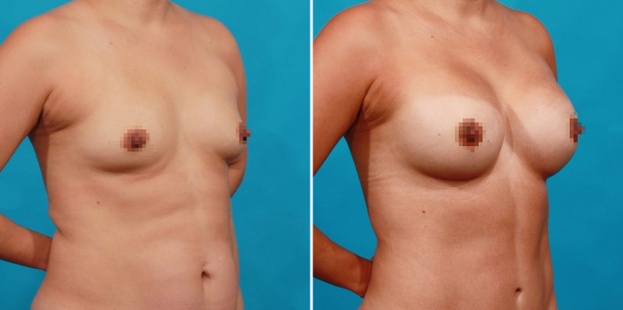 увеличение груди до и после