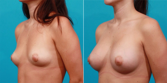 до и после увеличения груди