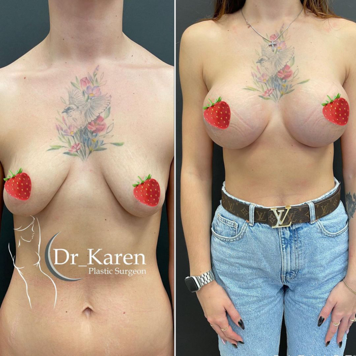 Подтяжка с увеличением груди