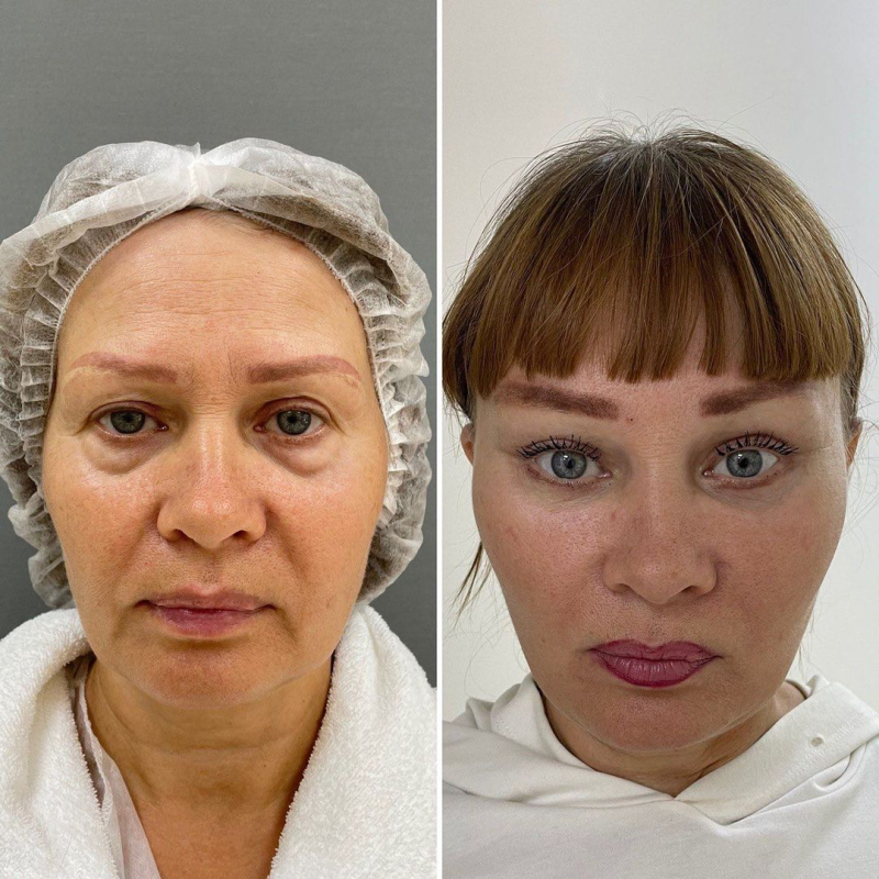  Пациентка доктора Четвериковой до и после омоложения лица