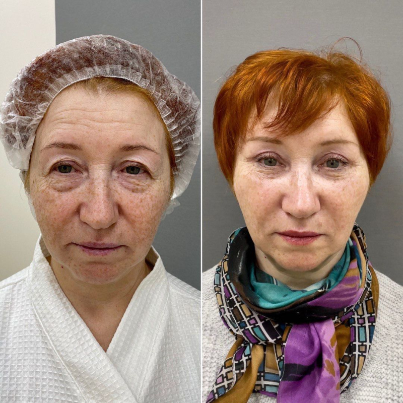  Пациентка доктора Четвериковой до и после омоложения лица