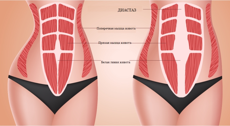 Диастаз и абдоминопластика