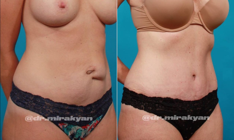 Пациентка доктора Гукаса Миракяна до и после абдоминопластики с устранением диастаза