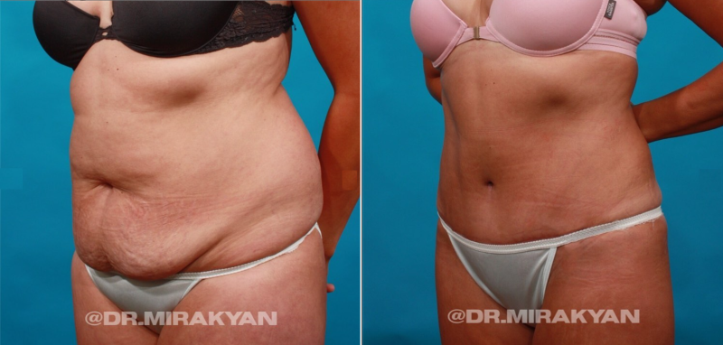 Пациентка доктора Гукаса Миракяна до и после абдоминопластики с устранением диастаза