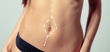 диастаз абдоминопластика