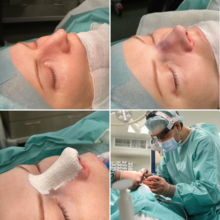 Ринопластика у пластического хирурга Валерия Стайсупова