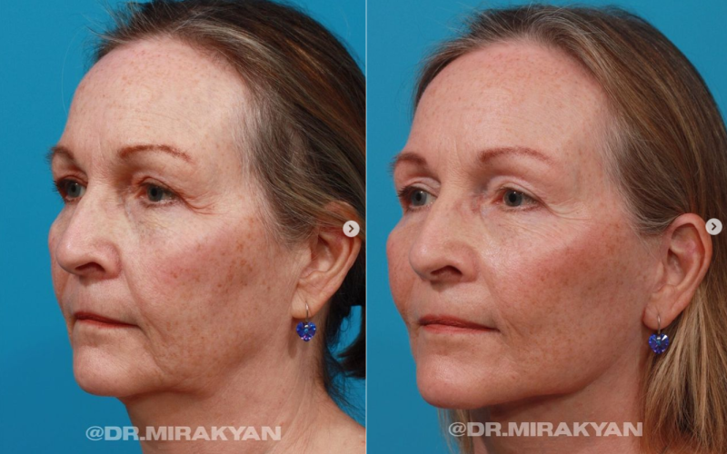 Пациентка пластического хирурга Гукаса Миракяна до и после омоложения