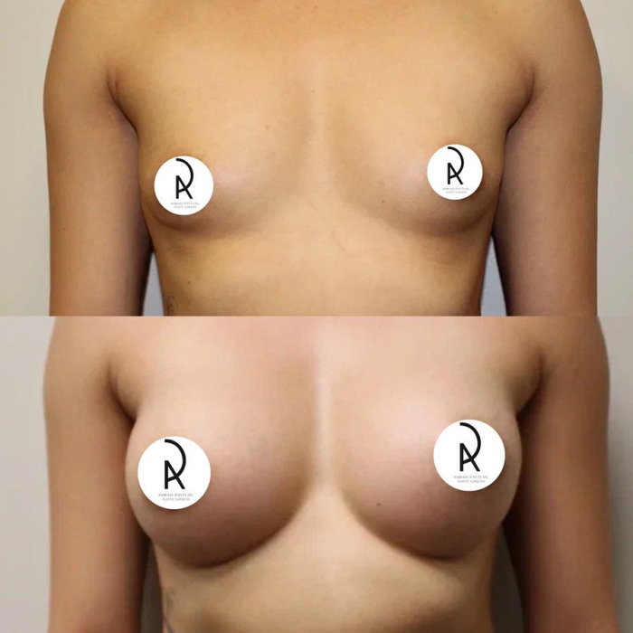 Пациентка пластического хирурга Амрама Пайтяна до и после увеличения груди имплантами