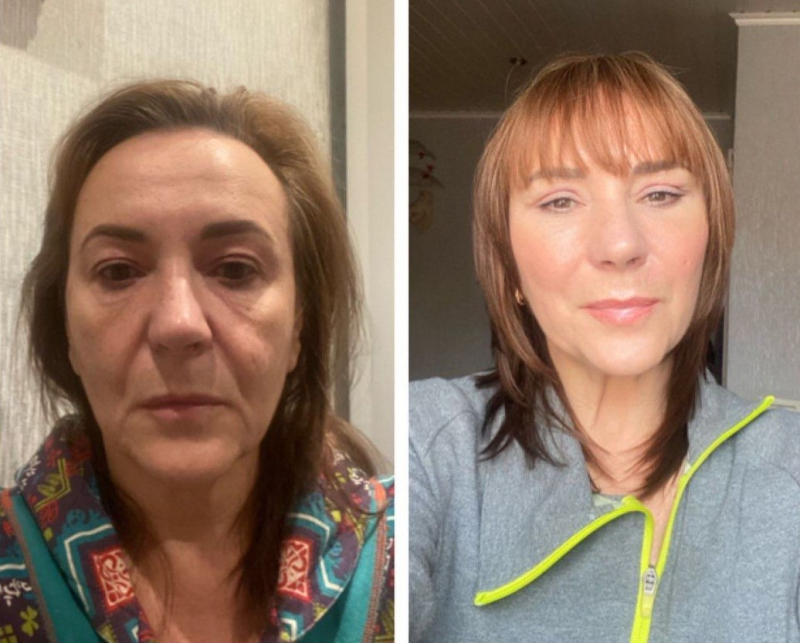 Пациентка пластического хирурга Марины Четвериковой до и после эндоскопической подтяжки верхней и средней зон лица