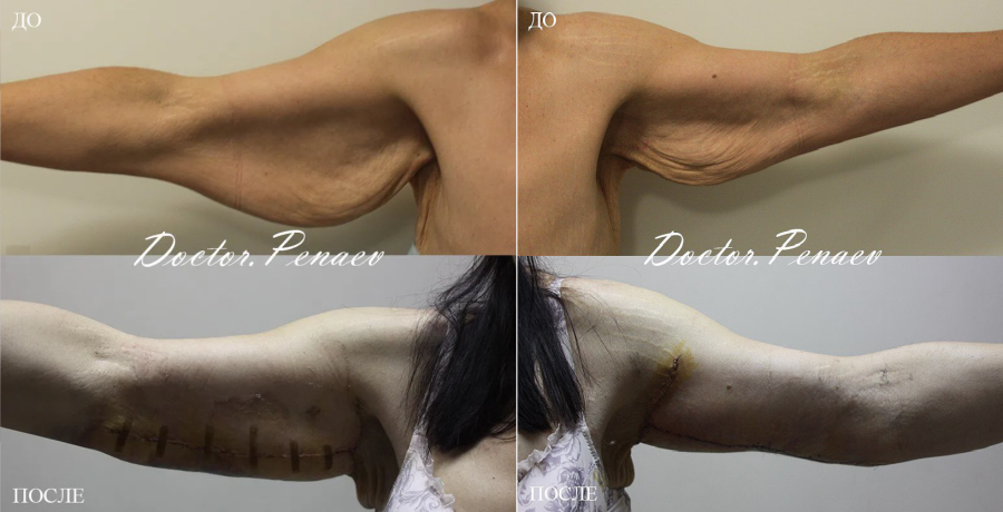 Пациентка пластического хирурга Арслана Пенаева до и после подтяжки рук