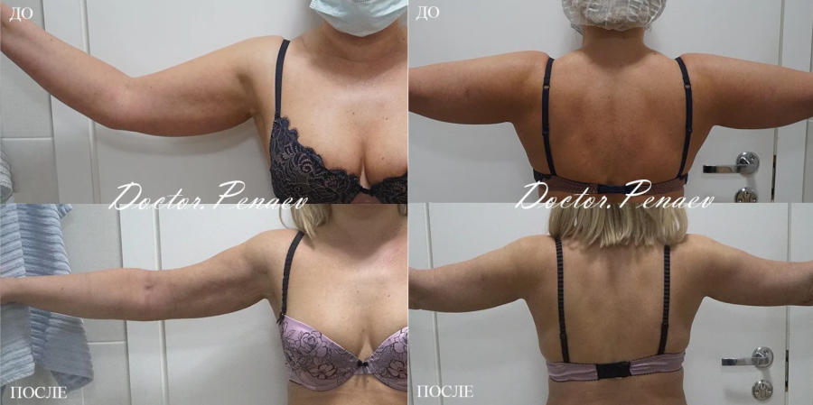 Пациентка пластического хирурга Арслана Пенаева до и после VASER-липомоделирования плеч