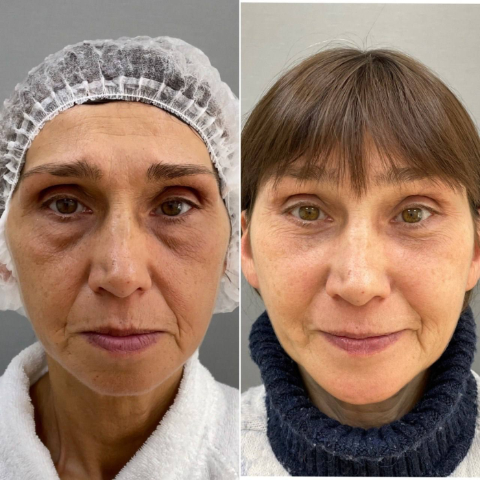 Пациентка пластического хирурга Марины Четвериковой до и после комплексного омоложения лица.