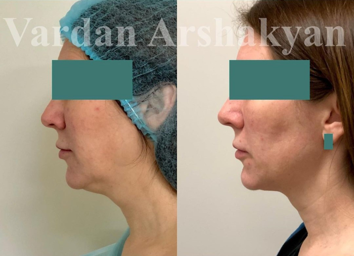 Пациентка доктора Вардана Аршакяна до и после радиочастотного омоложения лица ФейсТайт