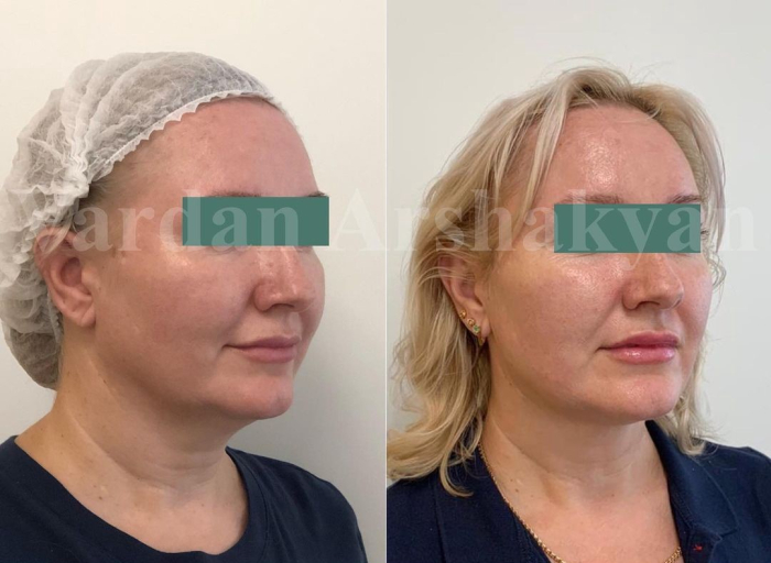 Пациентка доктора Вардана Аршакяна до и после радиочастотного омоложения лица ФейсТайт