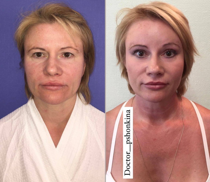 визаж лифт пшонкина