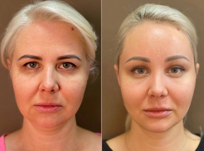 подтяжка лица Пшонкина