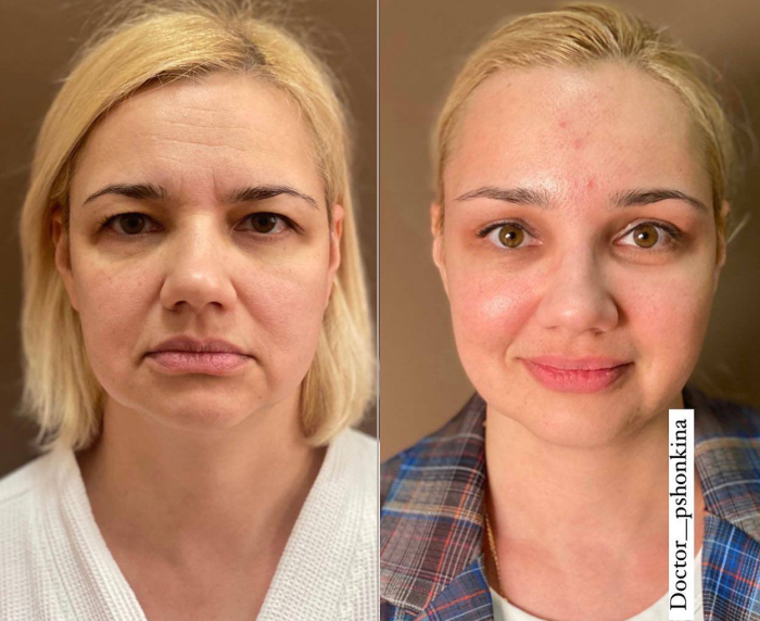 Пшонкина подтяжка