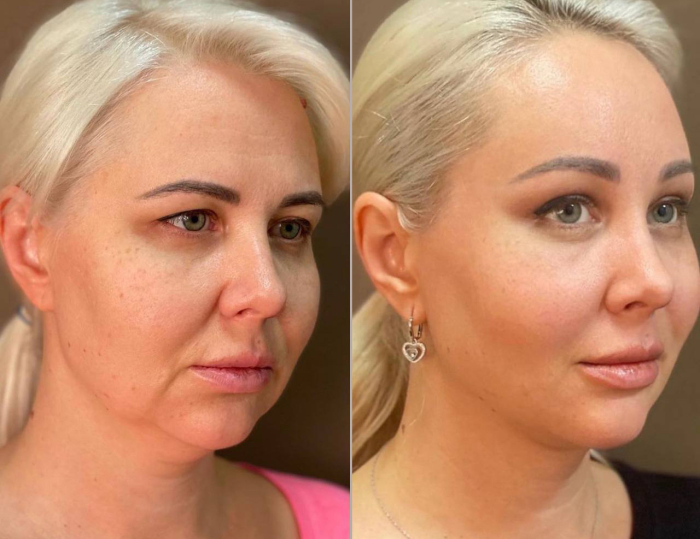 подтяжка лица Пшонкина