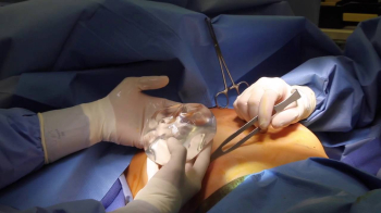 Увеличение груди имплантами