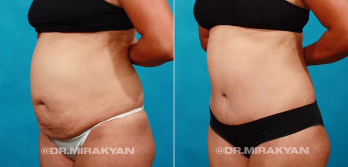 Пациентка пластического хирурга Гукаса Миракяна до и после абдоминопластики и липосакции.