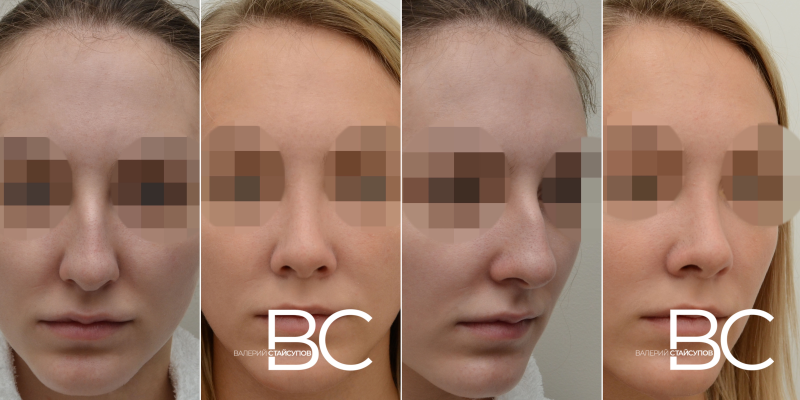 Пациентка пластического хирурга Валерия Стайсупова до и после ринопластики