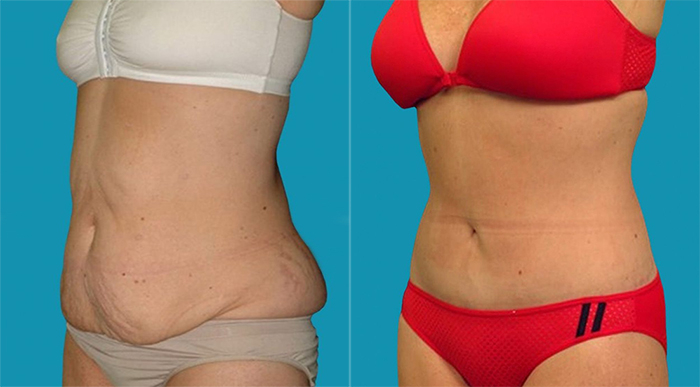 Пациентка доктора Гукаса Миракяна до и после абдоминопластики